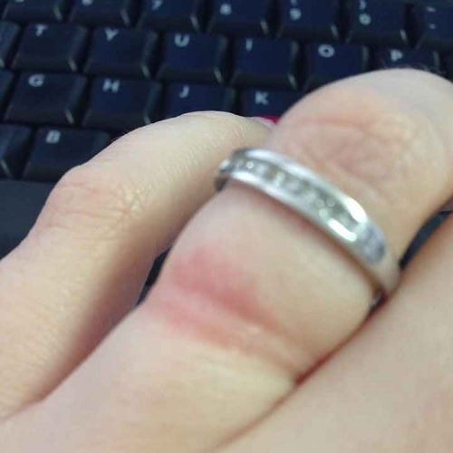 Đeo nhẫn bị dị ứng phải làm sao?